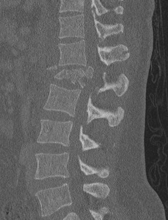 CT scan, burst fracture